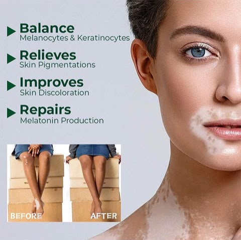 Vitiligo Herbal Cream
